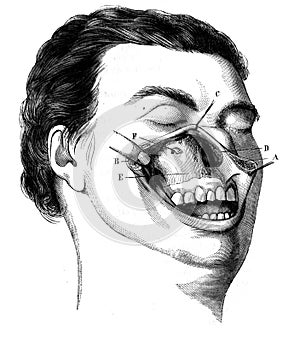 Anterior surface of the maxilla, discovered by the simple upper lip incision in the old book D`Anatomie Chirurgicale, by B. Anger