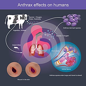 Ántrax efectos sobre el gente eso capaz causar muerte 