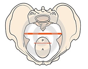 Anthrepoid Pelvis Shape with Round - Oval shape