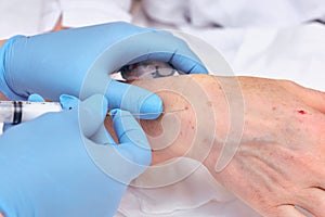 Anti-age injection therapy. Hand rejuvenation.