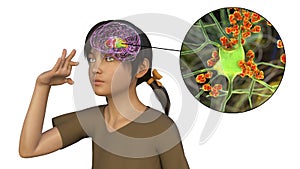 Anti-neuronal antibodies, anti-basal ganglia antibodies