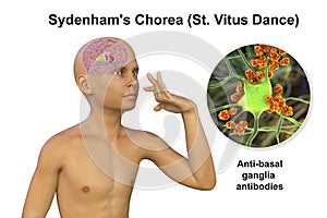 Anti-neuronal antibodies, anti-basal ganglia antibodies in a boy with chorea