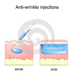 Anti-wrinkle injections. aesthetic procedure