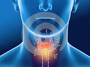 Antibodies attacking thyroid gland of a woman,  Autoimmune thyroiditis, Hashimoto`s disease .Antibodies attacking thyroid gland o