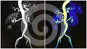 Aorta renal arteries kidneys mra collage photo