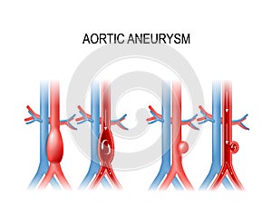 Aortic aneurysm. Vector illustration for medical use photo