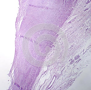 Aortic atherosclerosis, light micrograph