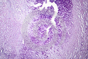 Aortic atherosclerosis, light micrograph