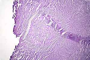 Aortic atherosclerosis, light micrograph