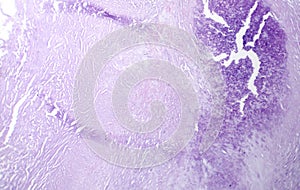 Aortic atherosclerosis, light micrograph