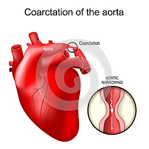 Aortic coarctations. Congenital heart defect