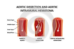 Aortic dissection and aortic intramural hematoma photo