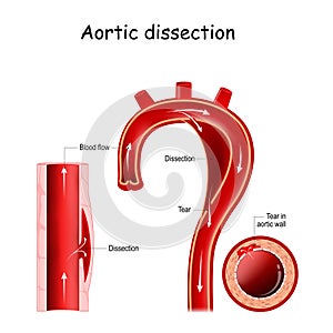 Aortic dissection. longitudinal and cross-section of blood vessel. photo