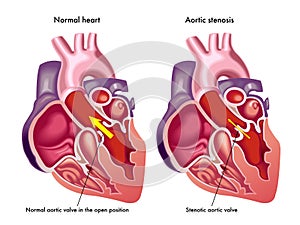 Aortic stenosis photo