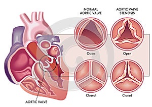 Aortic valve stenosis photo