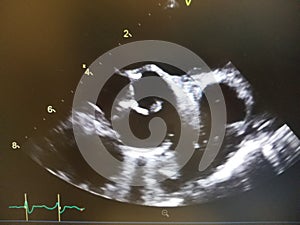 Aortic Valve Vegetation Shown on Live Echocardiogram