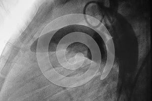 Aortography showed patent ductus arteriosus PDA in Pediatric patient