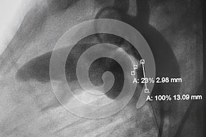 Aortography showed patent ductus arteriosus PDA in Pediatric patient photo
