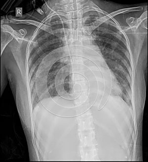AP View Chest Xray with ET Tube, CVP Line and Lung Infiltration