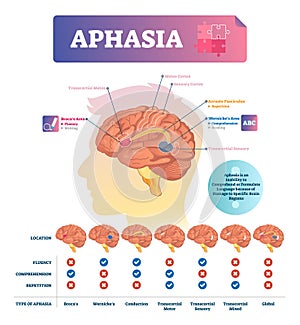 Aphasia vector illustration. Labeled educational scheme with brain disorder