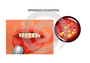 Aphthous stomatitis. aphthae photo