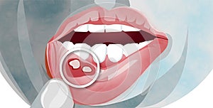 Aphthous stomatitis is a common condition characterized by the repeated formation of benign and non-contagious mouth ulcers photo