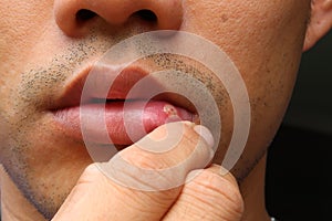 Aphthous stomatitis ,lip leison. asians human face. photo