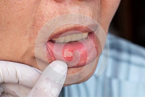 Aphthous ulcer, canker sore or stress ulcer in the mouth