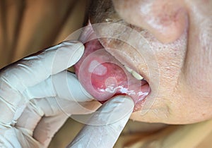 Aphthous ulcer or stress ulcer in mouth of Asian patient