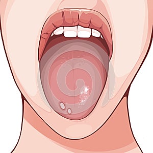 An aphthous ulcer is typically a recurrent round or oval sore or ulcer inside the mouth photo