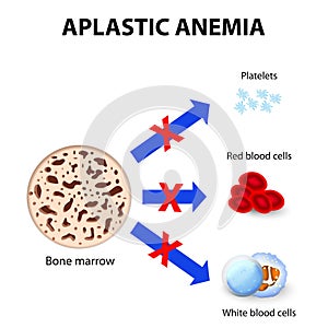 Aplastic anemia photo