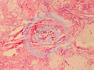 Apophysomyces hyphae cluster in tissue biopsy specimen photo
