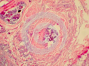 Apophysomyces hyphae cluster in tissue biopsy specimen photo