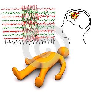 Apoplectic And Epileptic Stroke