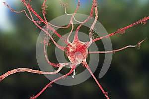 Apoptosis of neuron which is observed in different diseases