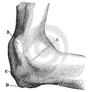 Appearance of the dislocated elbow joint.