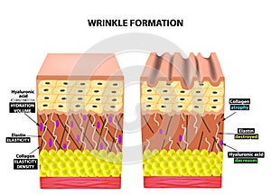 The appearance of wrinkles. Anatomical structure of the skin. Elastin, Hyaluronic acid, Collagen. Infographics. skin photo