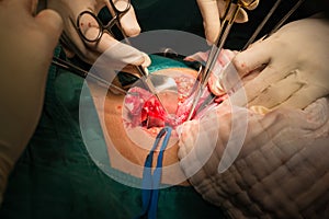 Appendectomy