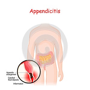 Appendicitis. closeup of appendix with Inflammation