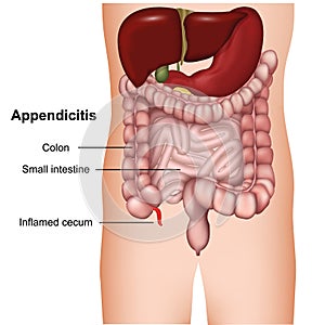 appendicitis 3d medical  illustration isolated on white background photo