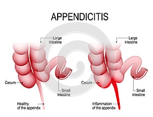 Appendicitis