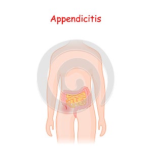 Appendicitis. human silhouette with a colon, small intestine and an inflamed appendix photo