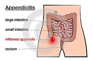 Appendicitis Inflamed Appendix Labeled Chart photo