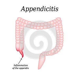 Appendicitis. Inflammation of the appendix. Colon. The illustration on background