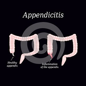 Appendicitis. Inflammation of the appendix. Colon. The illustration on a black background