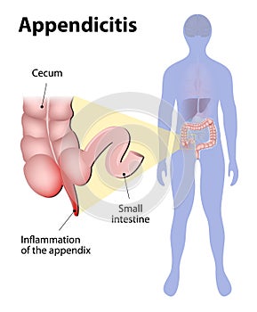 Appendicitis photo