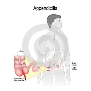 Appendicitis photo