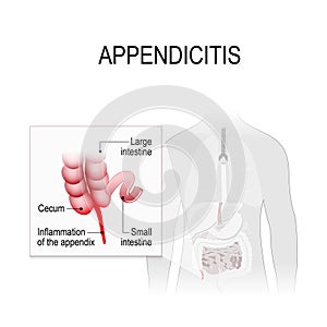 Appendicitis. Location in the human digestive system photo