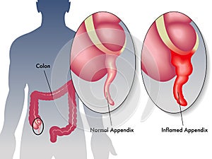 Appendicitis