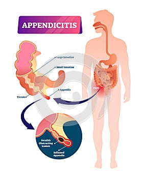 Appendicitis vector illustration. Labeled appendix inflammation pain scheme photo